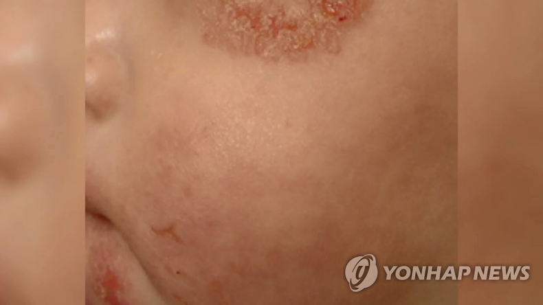 <strong>아토피 피부염</strong>