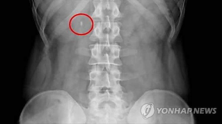 요로결석 엑스레이